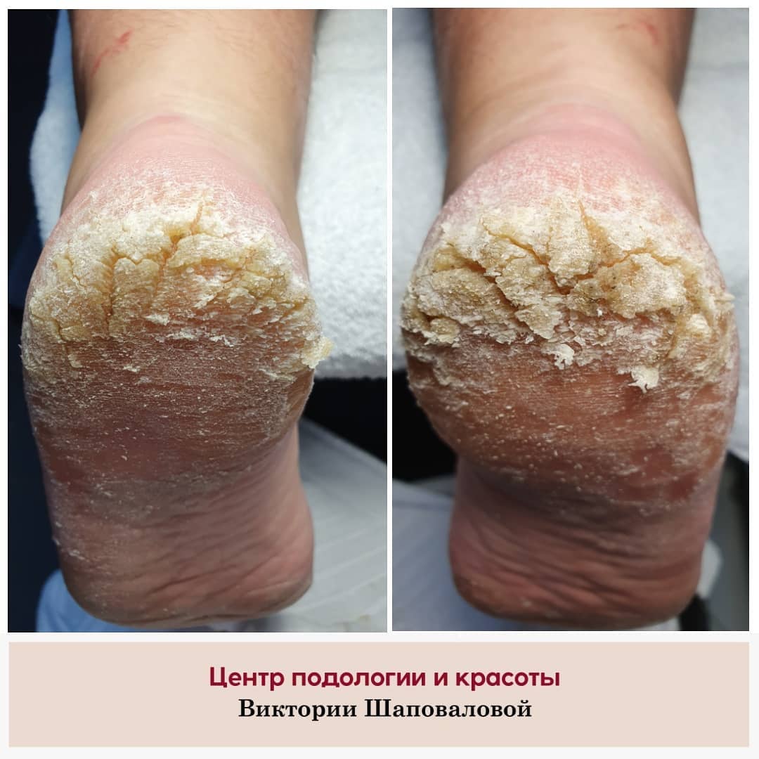 Глубокие (эпидермо-дермальные) трещины