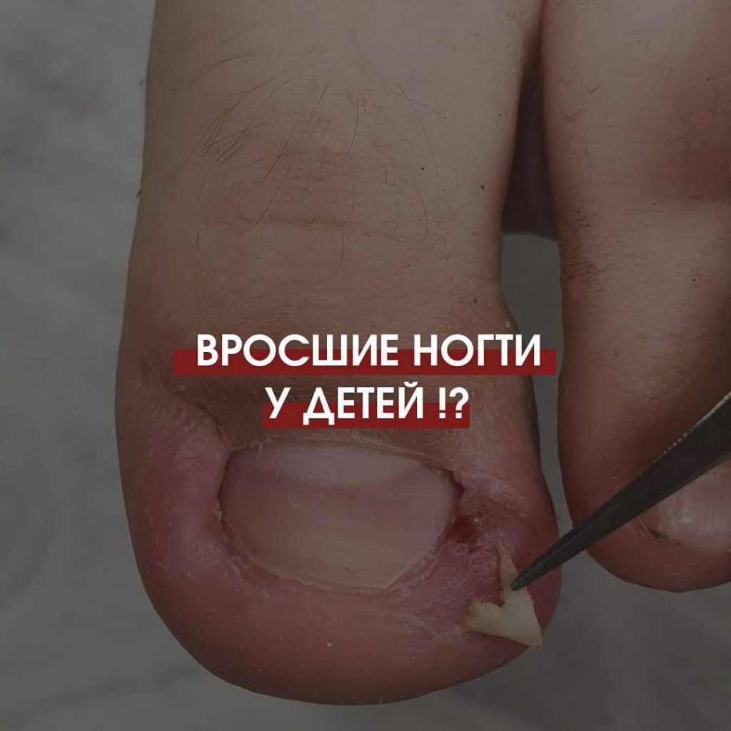 Вросшие ногти у детей - проблема родителей