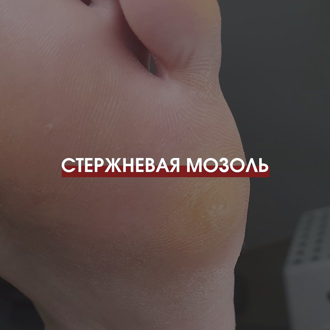 Стержневая мозоль