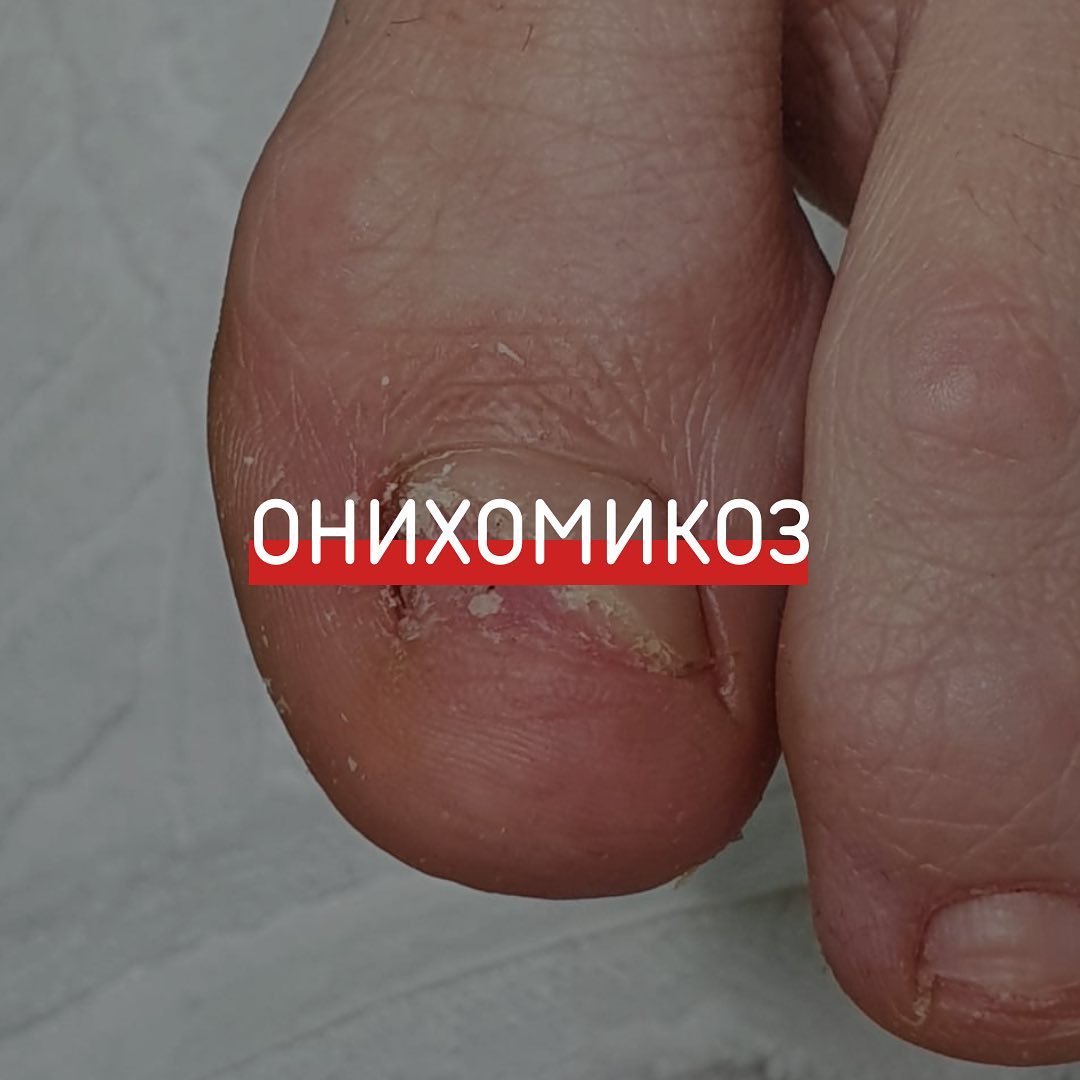 Онихомикоз